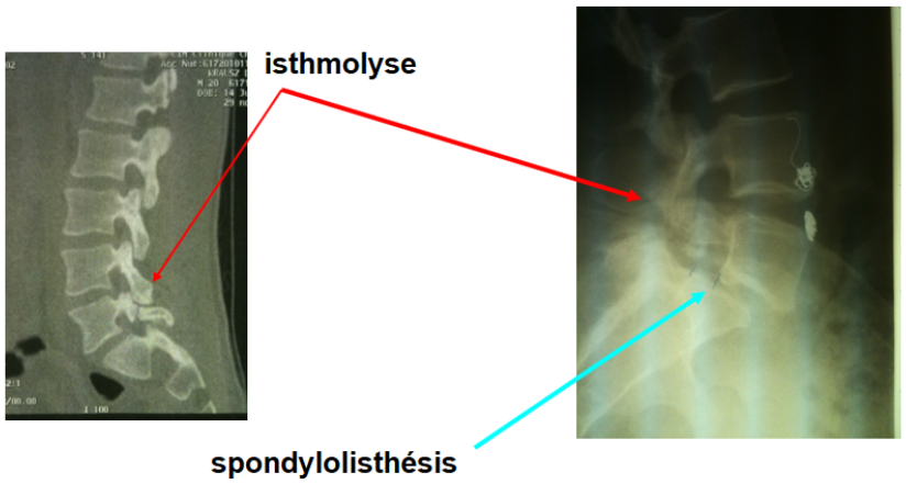 Spondylolisthésis-isthmiques-c1