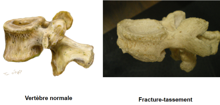 fracture-c1