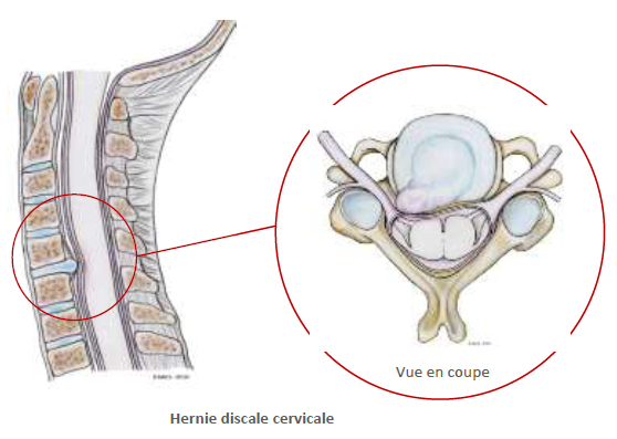 hernie-discale-cervicale-2